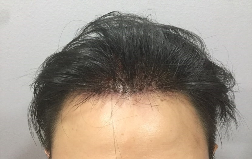 수술 후