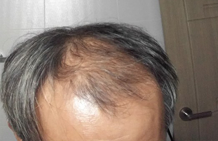 프로페시아,로게인폼 사용 3개월째