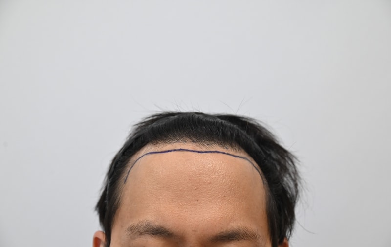 "Congressman MoM" hair transplant review.