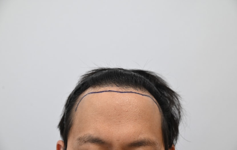 시술 전