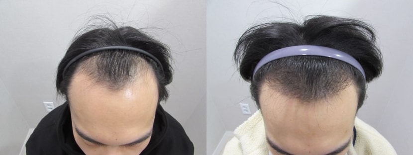 수술전 &gt; 수술후