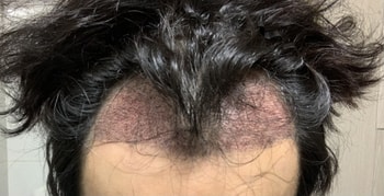 모발이식 2일차