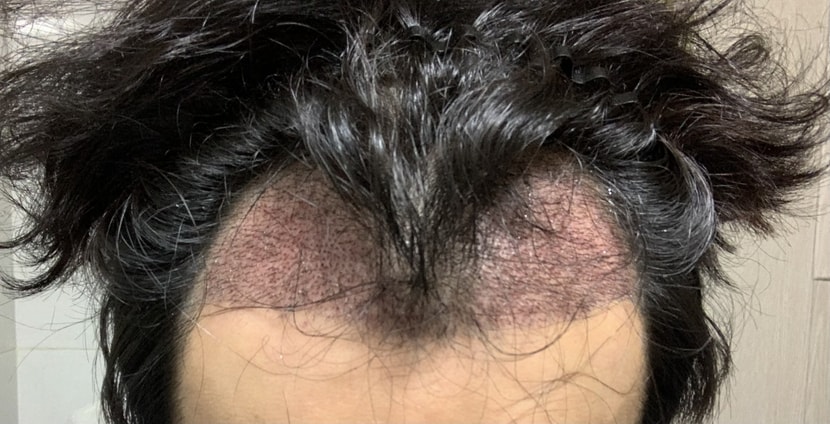 모발이식 2일차