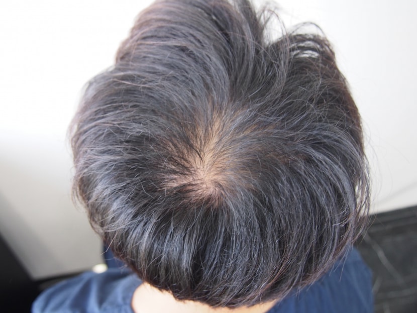 정수리