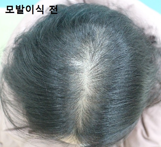 모발이식 전