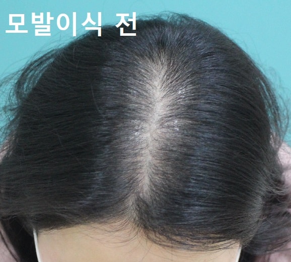 모발이식 전