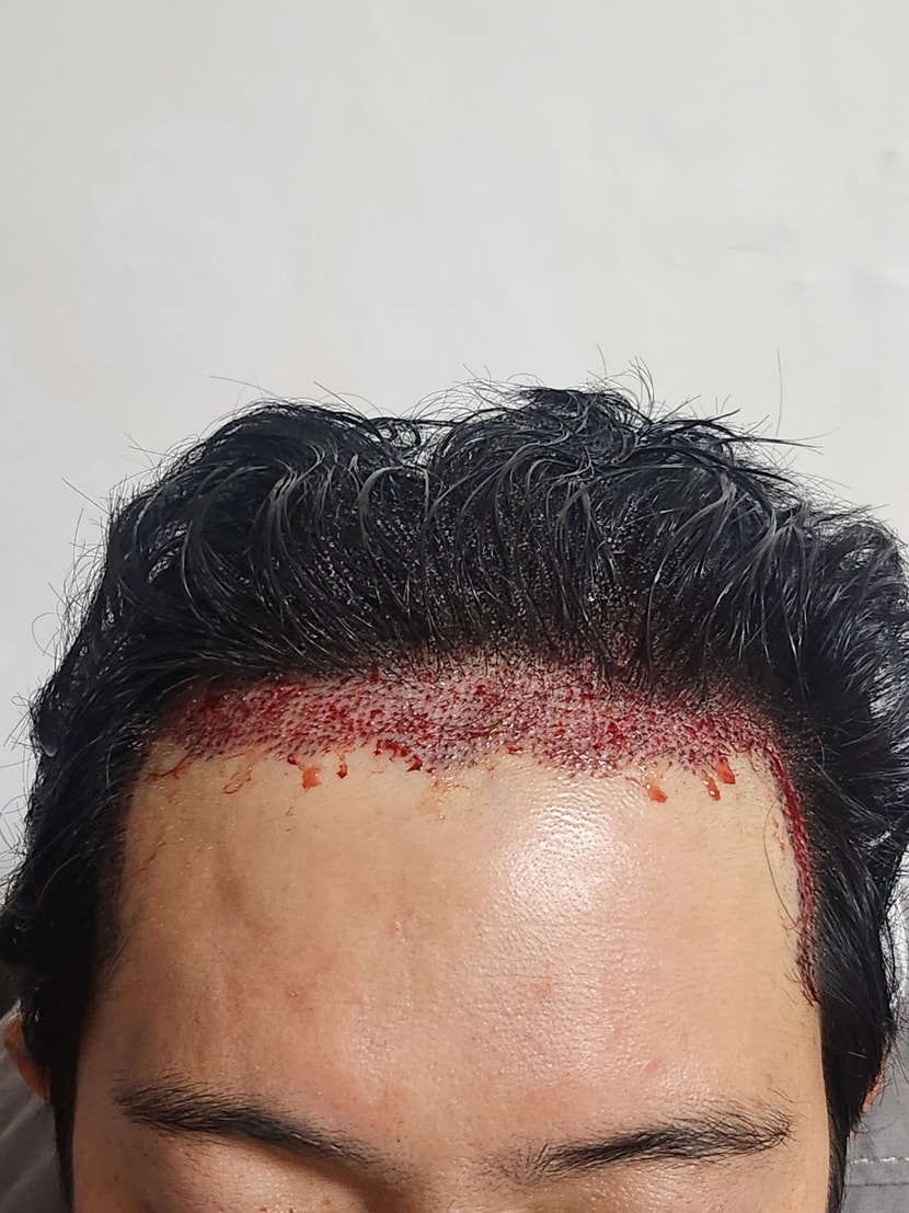 수술 1일차
