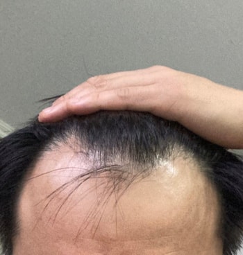 이식전