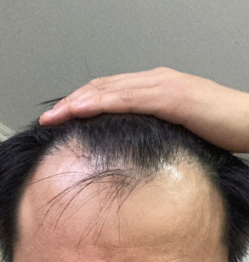 이식전