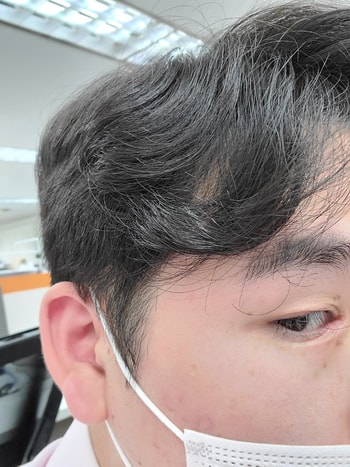 수술 2년후 현재