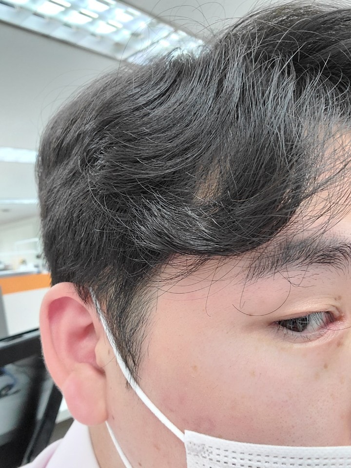 수술 2년후 현재