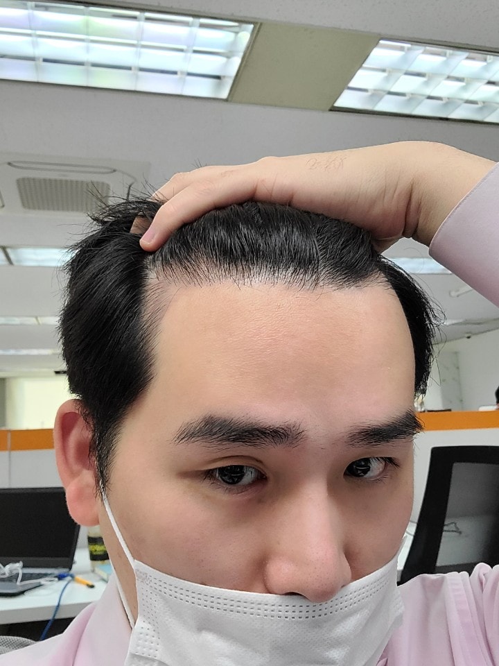 수술 2년후 우