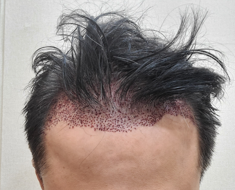 이식 당일