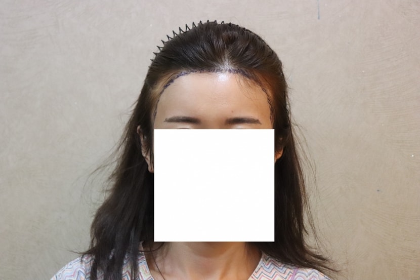 수술전디자인(정면)