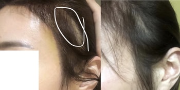 8월29일보강후흉터부분