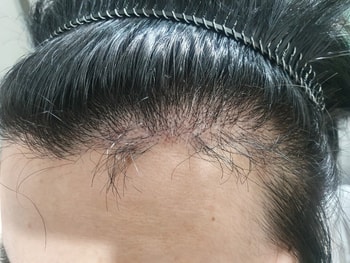 현재(재수술 1개월차)