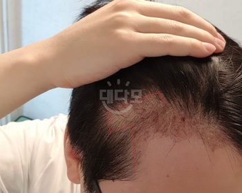 동반탈락 시작