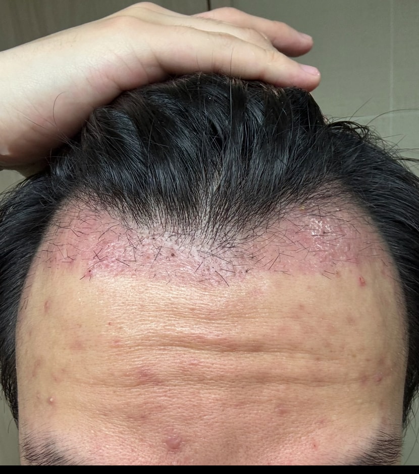 암흑기 사진입니다 붉은곳이 이식부위에요