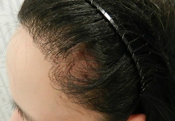 2차 수술 후 염증이 더 심해짐