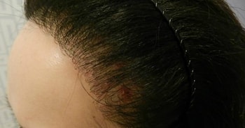 2차 수술 후 염증이 더 심해짐