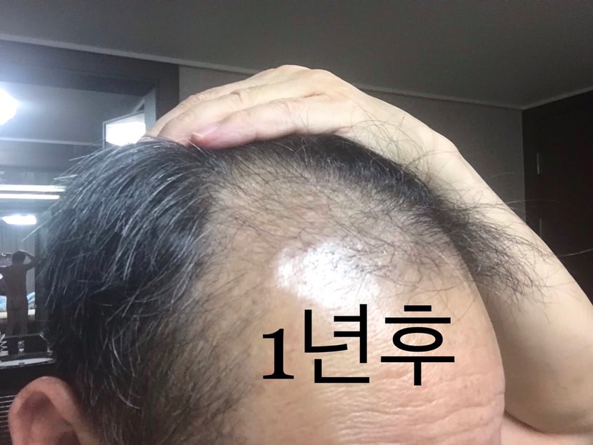 1년후