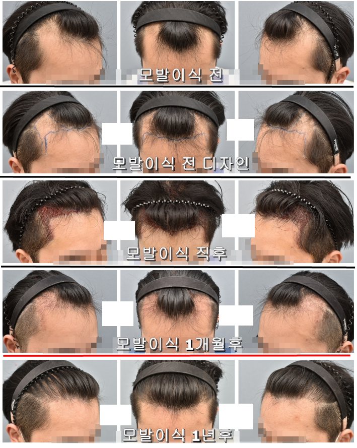 수술 후 1년