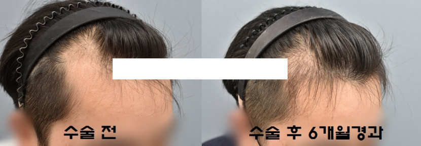 수술 후 6개월