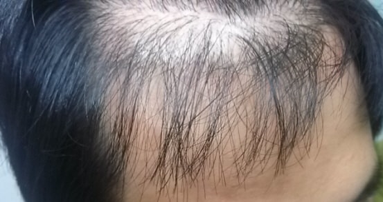 11개월 경과