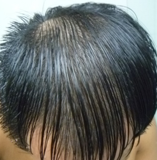 수술 전 젖은머리
