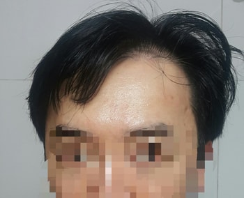이식후1년(01)