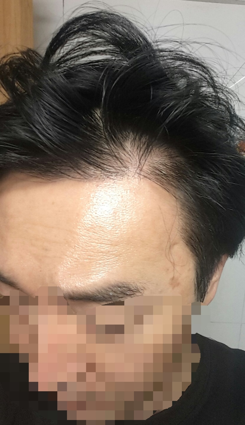 이식후1년(03)
