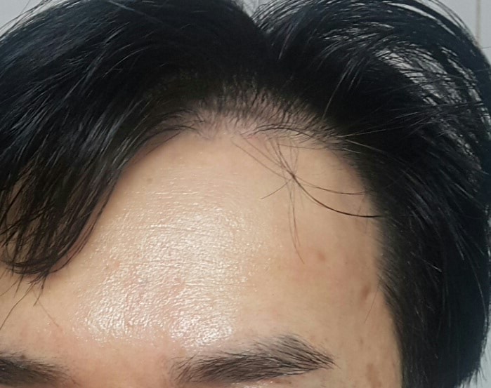 이식후1년(02)