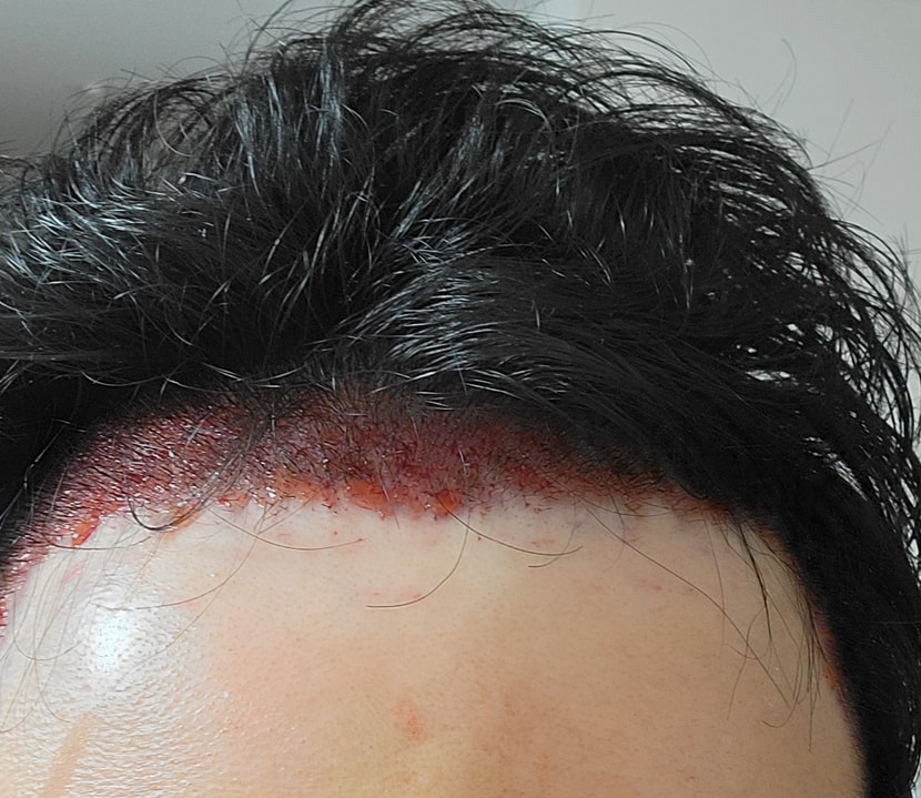 수술후 당일 사진