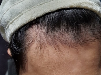 4개월차 좌측