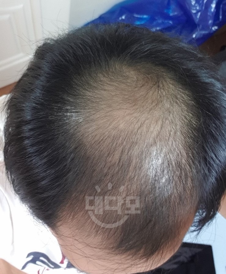 19년 4월말 이후 상태를 보는데 제가 이식실패사례인지 아닌지 긴가민가하여 판단해주십사 글올려드립니다