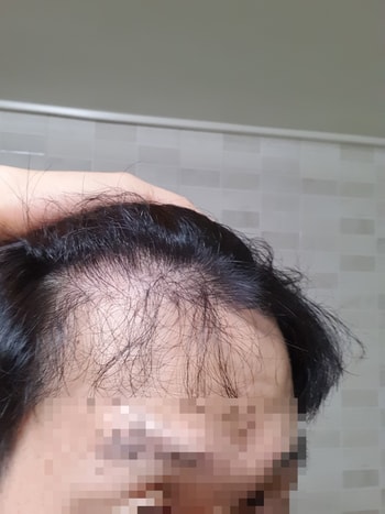 1년 4개월차 왼쪽