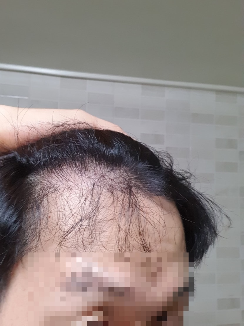 1년 4개월차 왼쪽