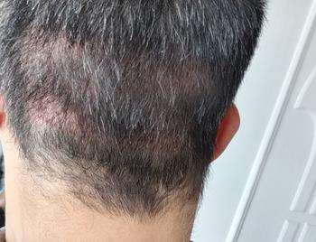 삭발후 비절개 모발이식 한달후 후두부