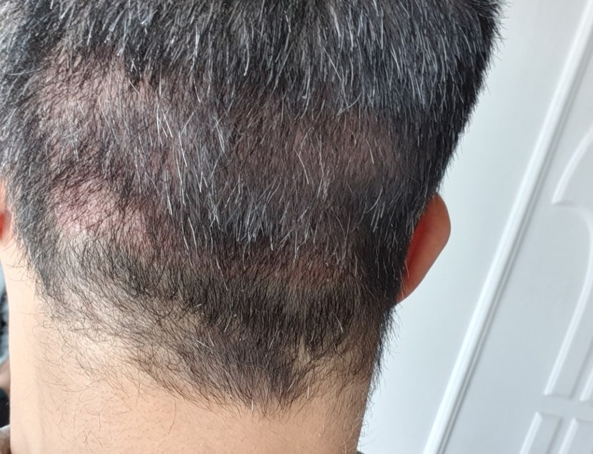 삭발후 비절개 모발이식 한달후 후두부