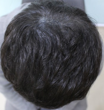 1차 수술 후 10일