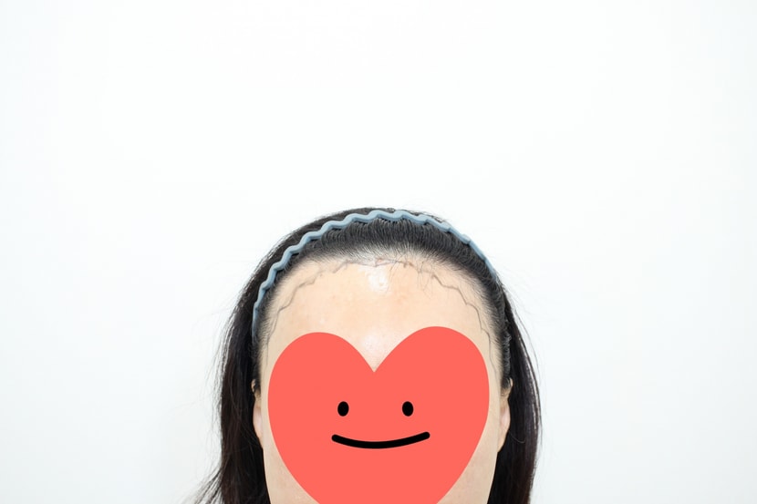 시술전 정면