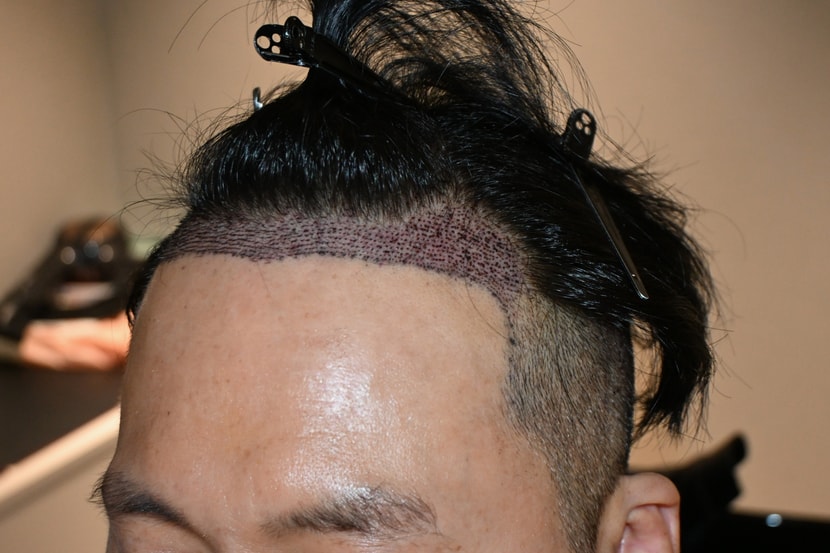수술후 2일차