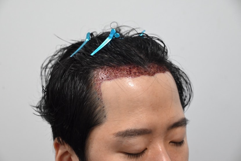 수술 당일