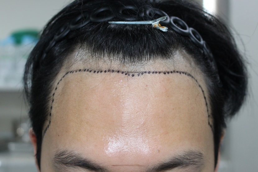 수술전