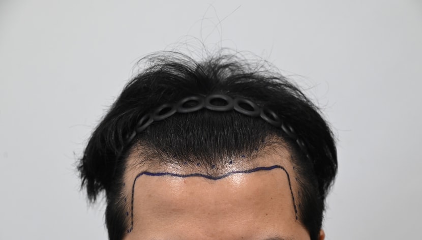 수술전