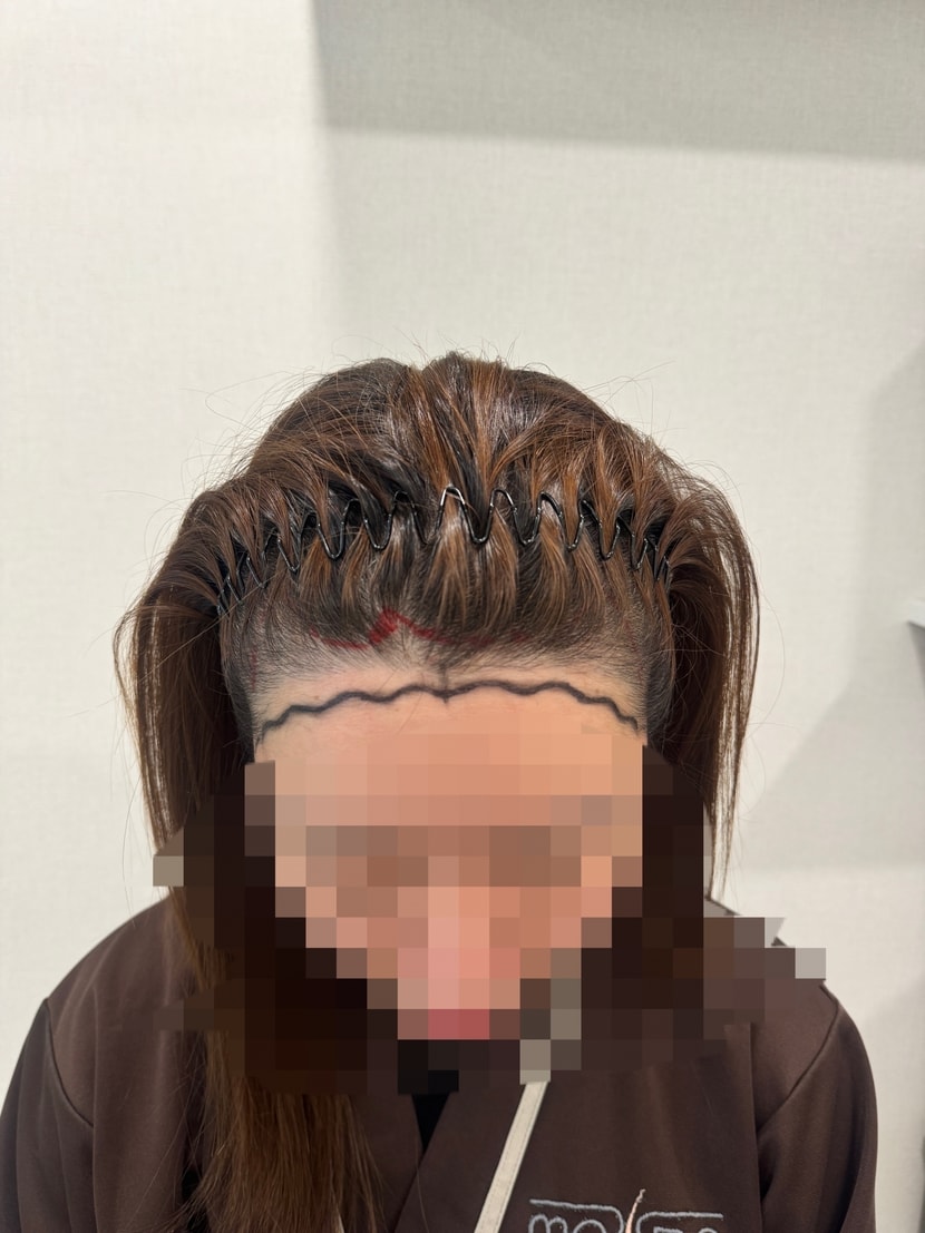 수술 당일 디자인 후