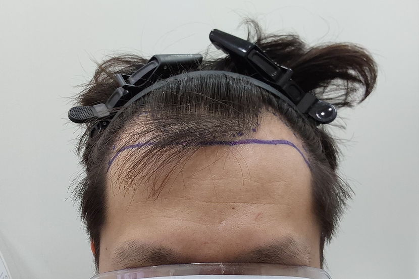 수술전 입니다