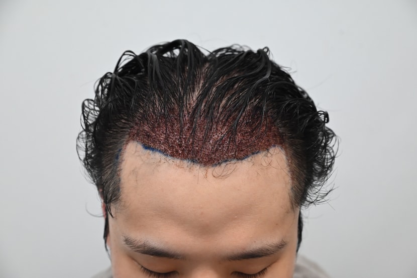 시술 후 첫 샴푸