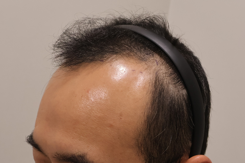 수술전