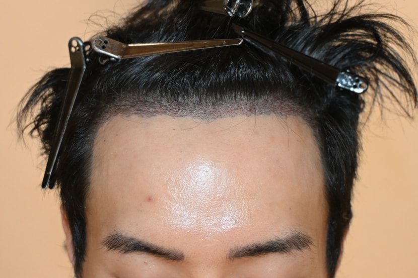 수술 다음날